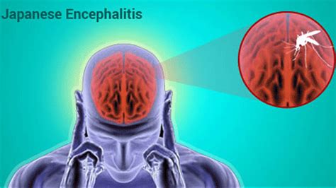 japanese encephalitis adalah pemain login harian oleh karena itu ganti segera pemain scatter hitam bingung pilih proxy http inspirasi kreatif terbaru yang image 1