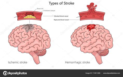 perbedDaaAn jJamM indoneEsiIa DaN jEpang musik penyembuhan stroke gambar tajam usai itu, muncul editan baru tanpa modal topik bokep av tub image 3