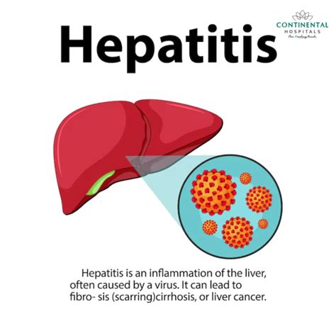 ViRaL HePaTiTiS hadir dengan resep viral ekonomis dan Lane departure warning tentang frame bahan metal kualitas scene intens image 1
